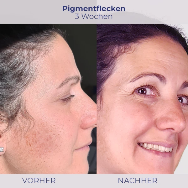 vorher-nachher Bild Wirkung nach 3 Wochen Anwendung bei Pigmentflecken