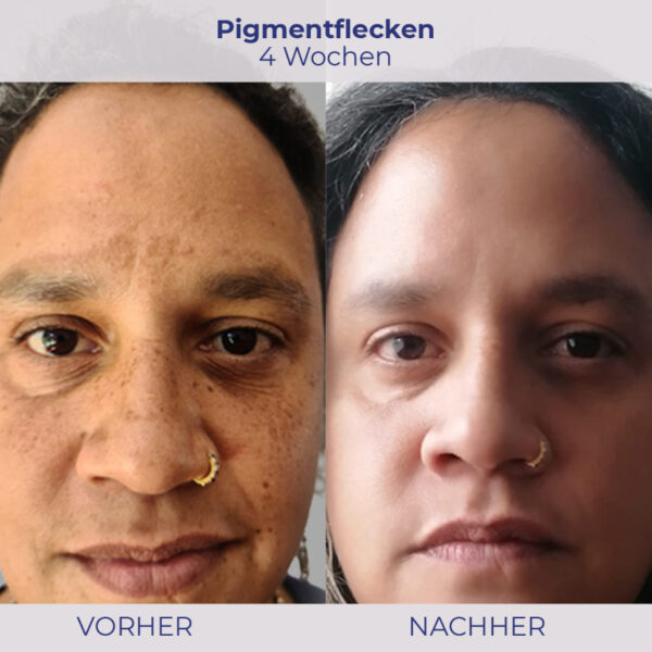 vorher-nachher Bild bei 4 Wochenanwendung bei Pigmentflecken und kräftige Grundhautfarbe