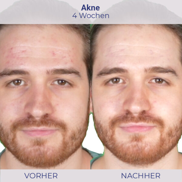 vorher-nachher Bild bei 4 Wochen Anwendung wegen Akne